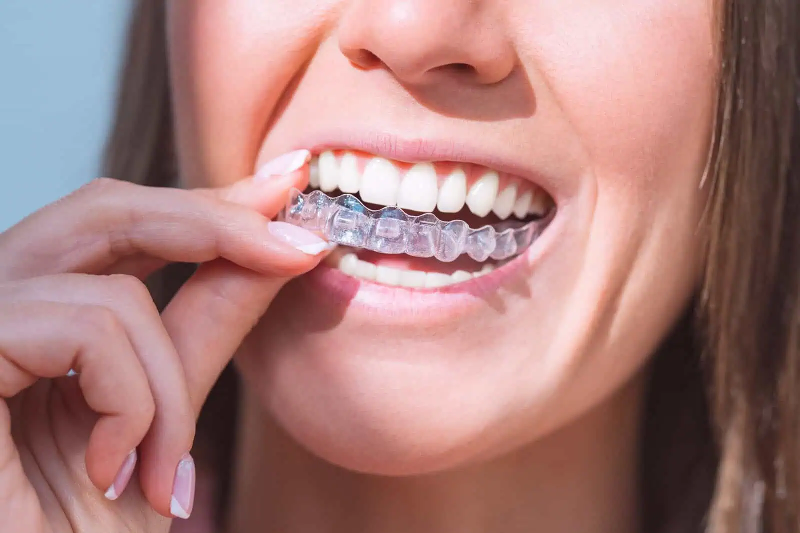 Clear Aligners (SureSmile)