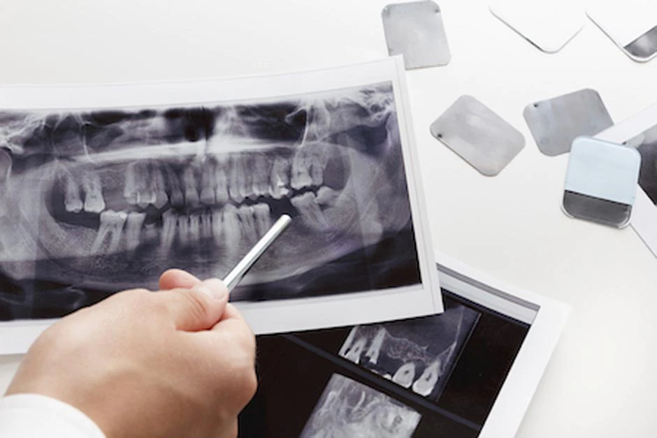 Root Canal Therapy
