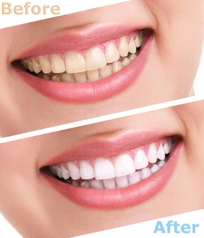 teeth whitening services Woburn, MA